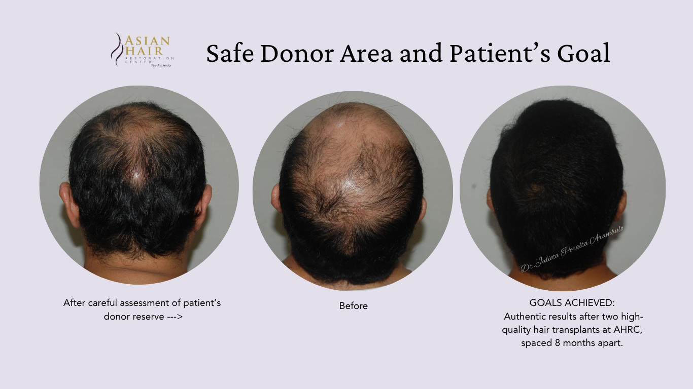 Hair Transplant in the Philippines | Before and After Results