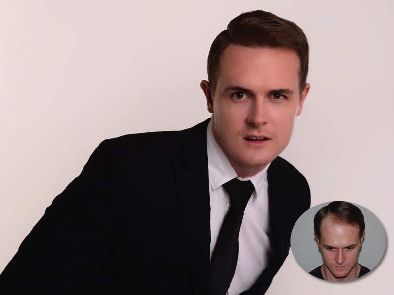 Dwaine Woolley’s Hair Transplant Journey