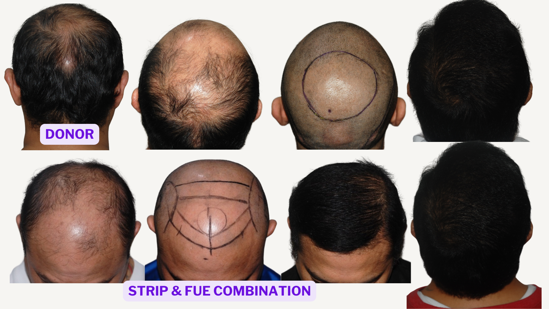 Hair Transplant in the Philippines | FUE and Strip Donor Results
