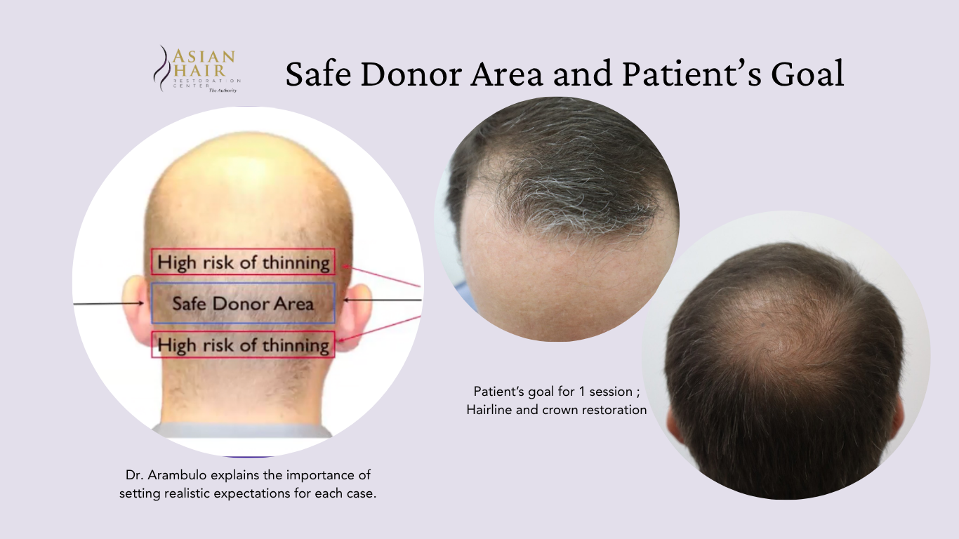 Hair Transplant in the Philippines | Before and After Results